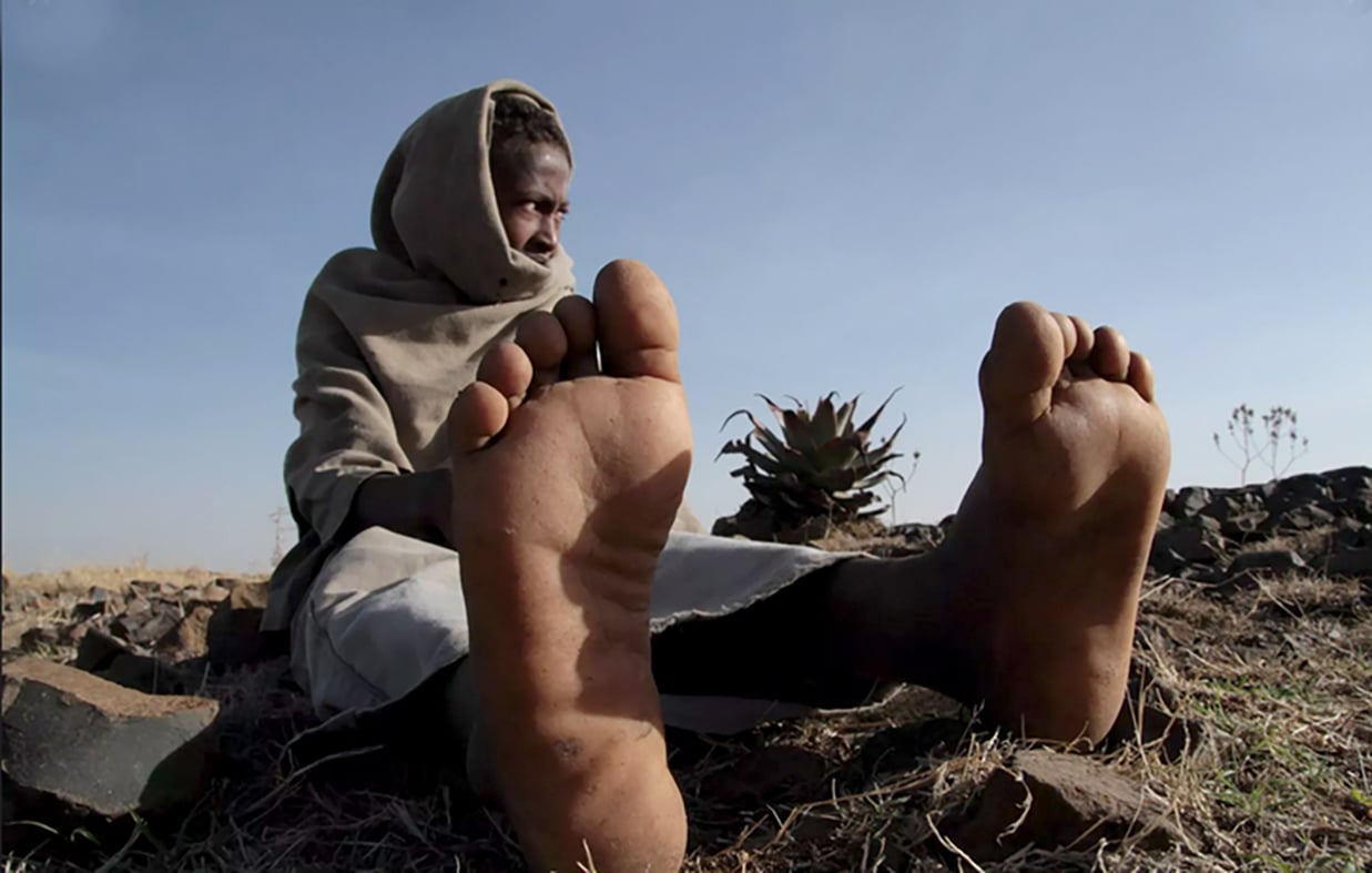 Preventing-Mycetoma-Sudan-2019